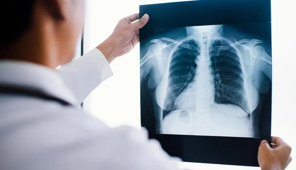 Anvisa aprova novo medicamento para câncer de pulmão avançado